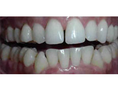 Invisalign to correct upper moderate spacing and sever lower crowding.
